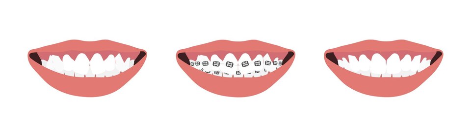 The Significance of Early Teeth Realignment: A Comprehensive Guide