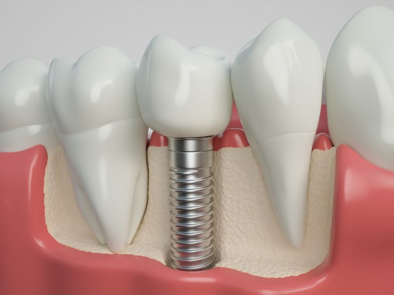 dental implant